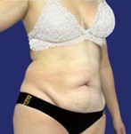 Patient corrective abdominoplasty for hanging skin  - Fleur-de-Lis Tummy Tuck