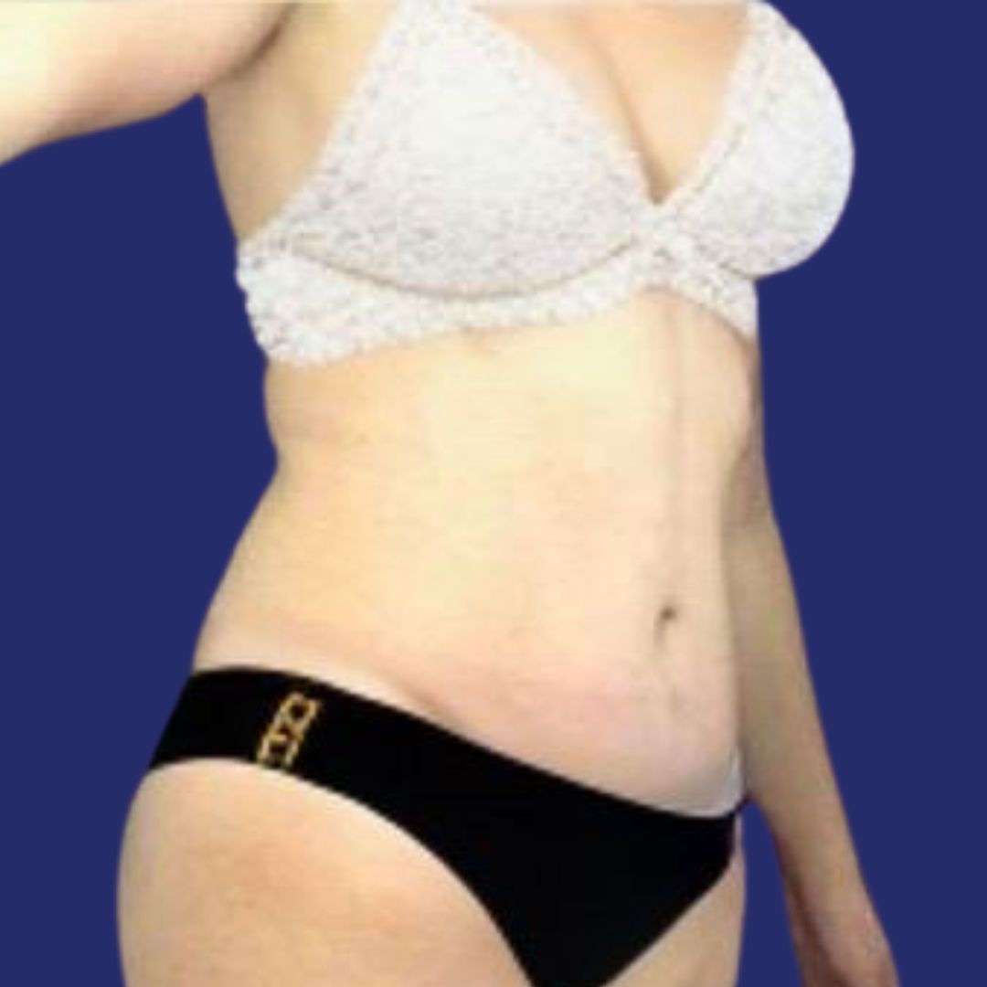 Paciente con abdomen corregido después de cirugía plástica recupera firmeza de la piel en el abdomen