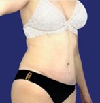 Patient with corrected abdomen after plastic surgery regains firmness in abdominal skin