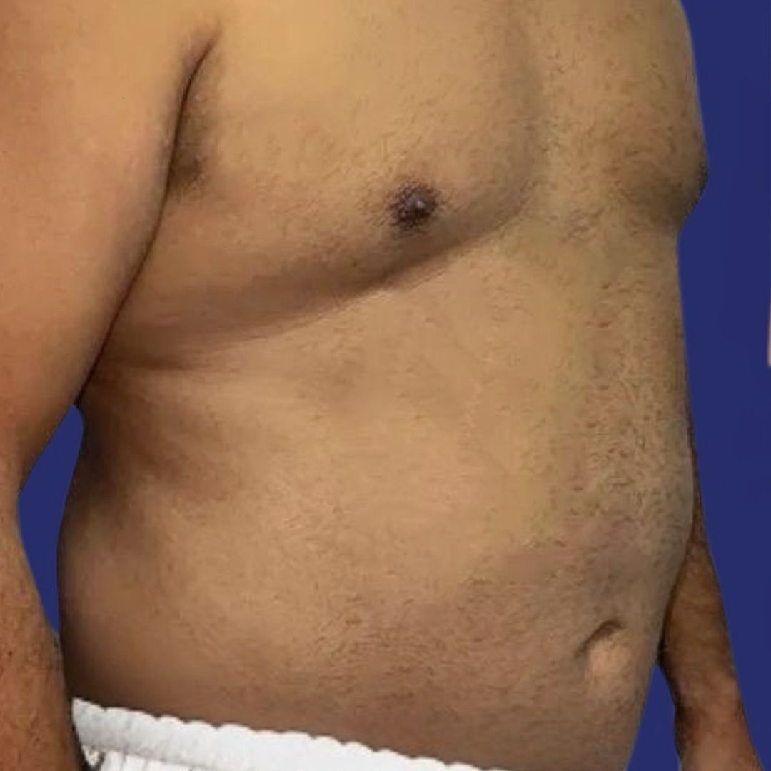 Paciente antes de cirugía abdominal hombre