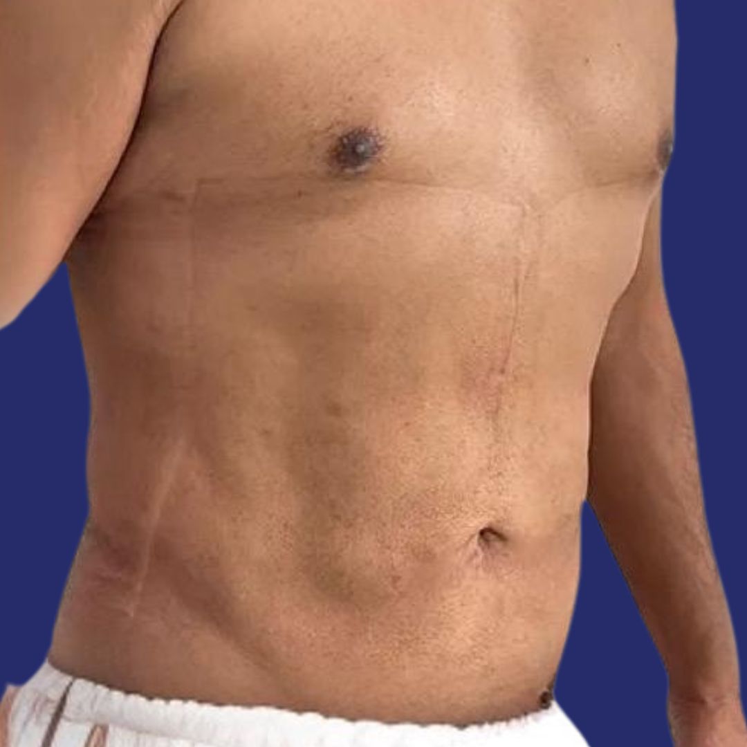 Paciente con músculos abdominales hombre restaurados tras cirugía de abdominoplastia