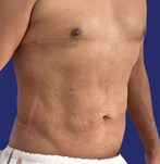 Male patient with restored abdominal muscles after abdominoplasty