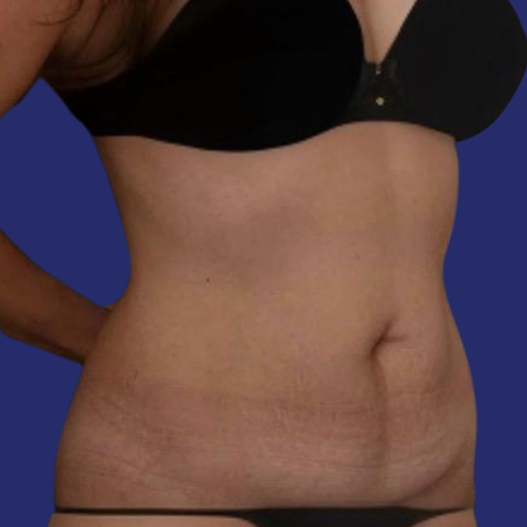 Paciente abdomen antes de abdominoplastia reconstructiva