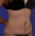 Patient abdomen before reconstructive abdominoplasty