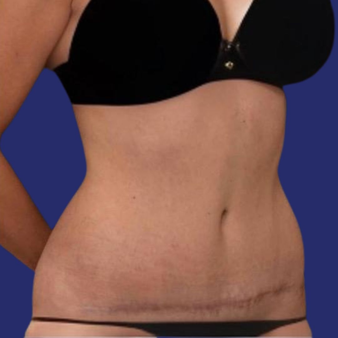 Paciente con abdomen cicatrizado y reconstruido después de abdominoplastia foto cicatriz