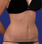 Patient with healed and reconstructed abdomen after tummy tuck scar