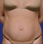 Patient with loose skin on the abdomen before plastic surgery