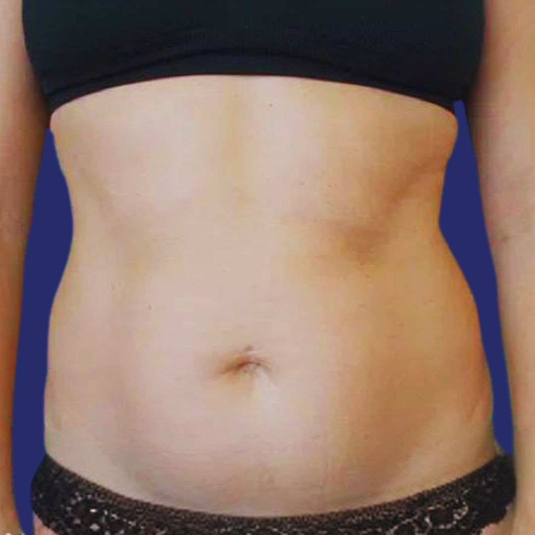 Candidata con abdomen ligeramente caído antes de mini abdominoplastia estética