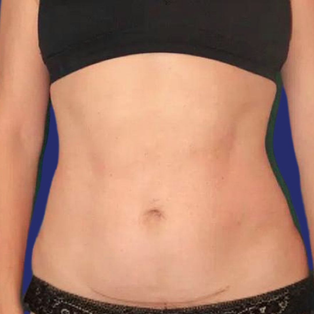 Candidata con abdomen estéticamente mejorado tras mini abdominoplastia