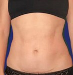 Candidate with aesthetically improved abdomen after mini abdominoplasty