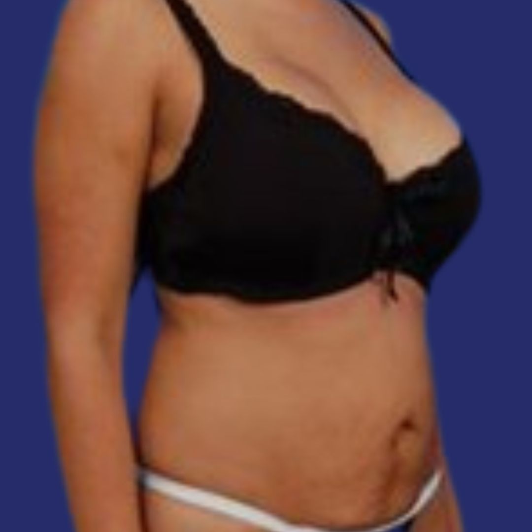 Fotos de (mini) abdominoplastia