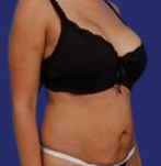 (Mini) tummy tuck photos