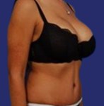 Mini tummy tuck before and after photos