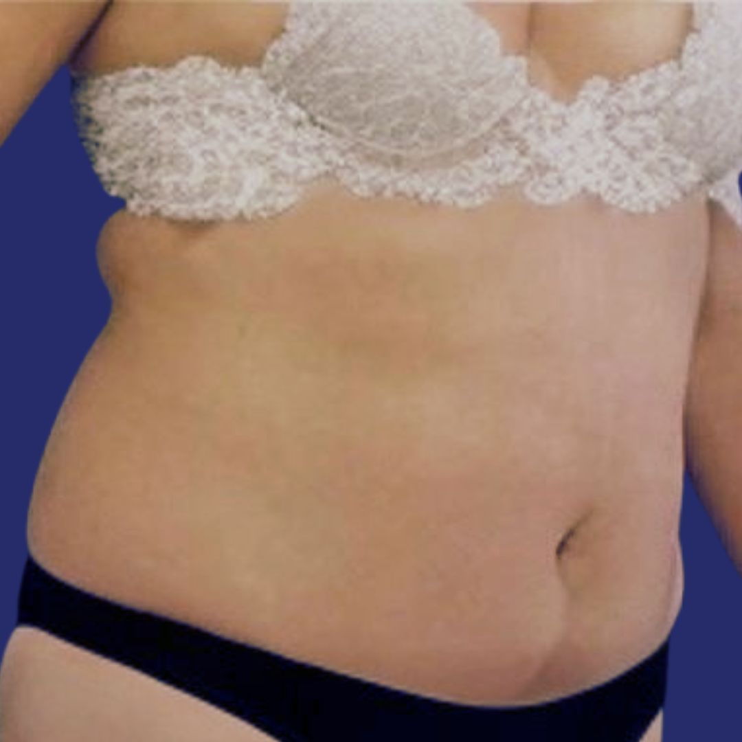 Paciente con sobrepeso moderado antes de abdominoplastia para reducir grasa abdominal
