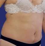Total tummy tuck before and after photos