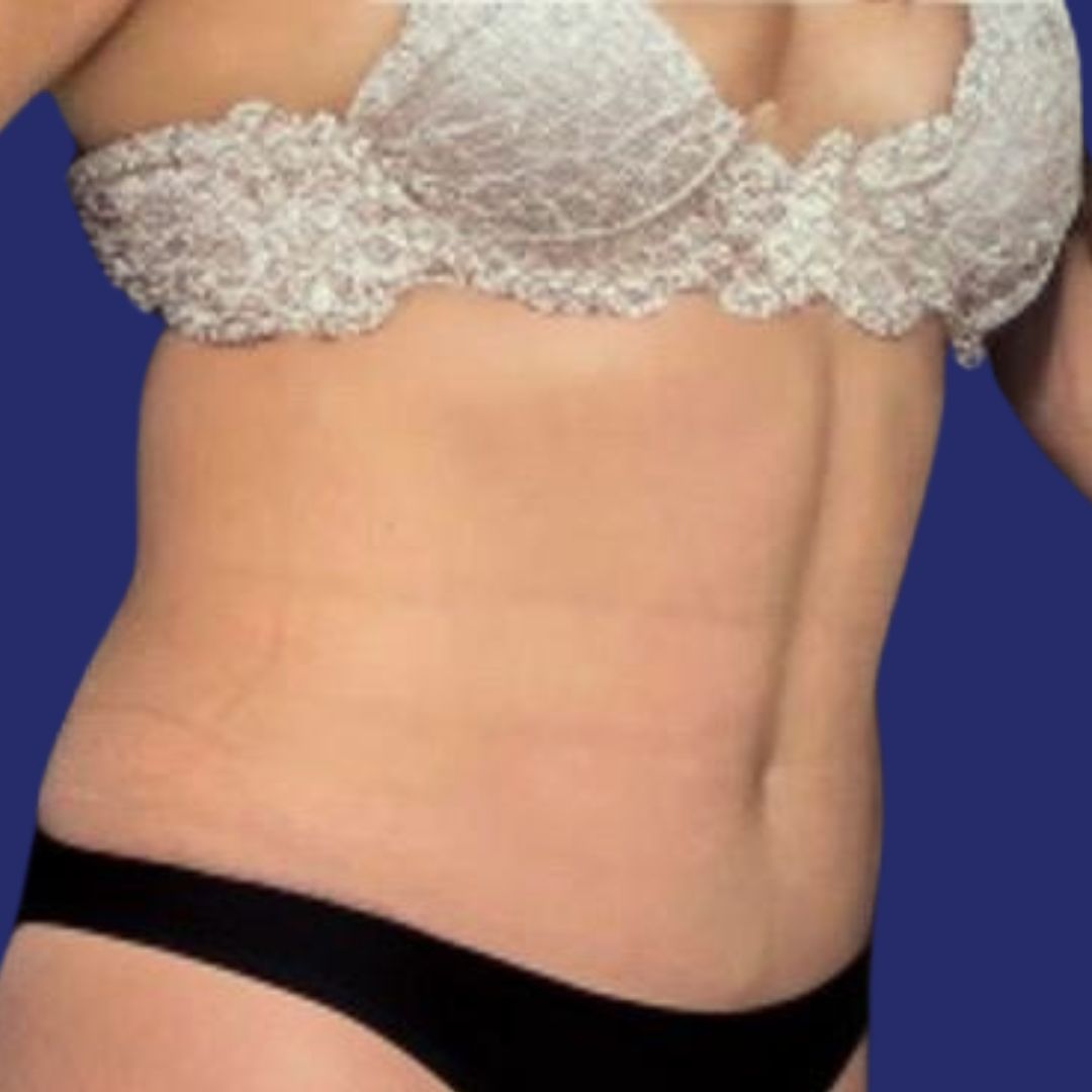 Paciente con abdomen reducido y firme tras abdominoplastia