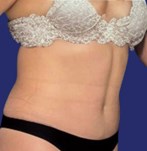 Patient with reduced and firm abdomen after abdominoplasty