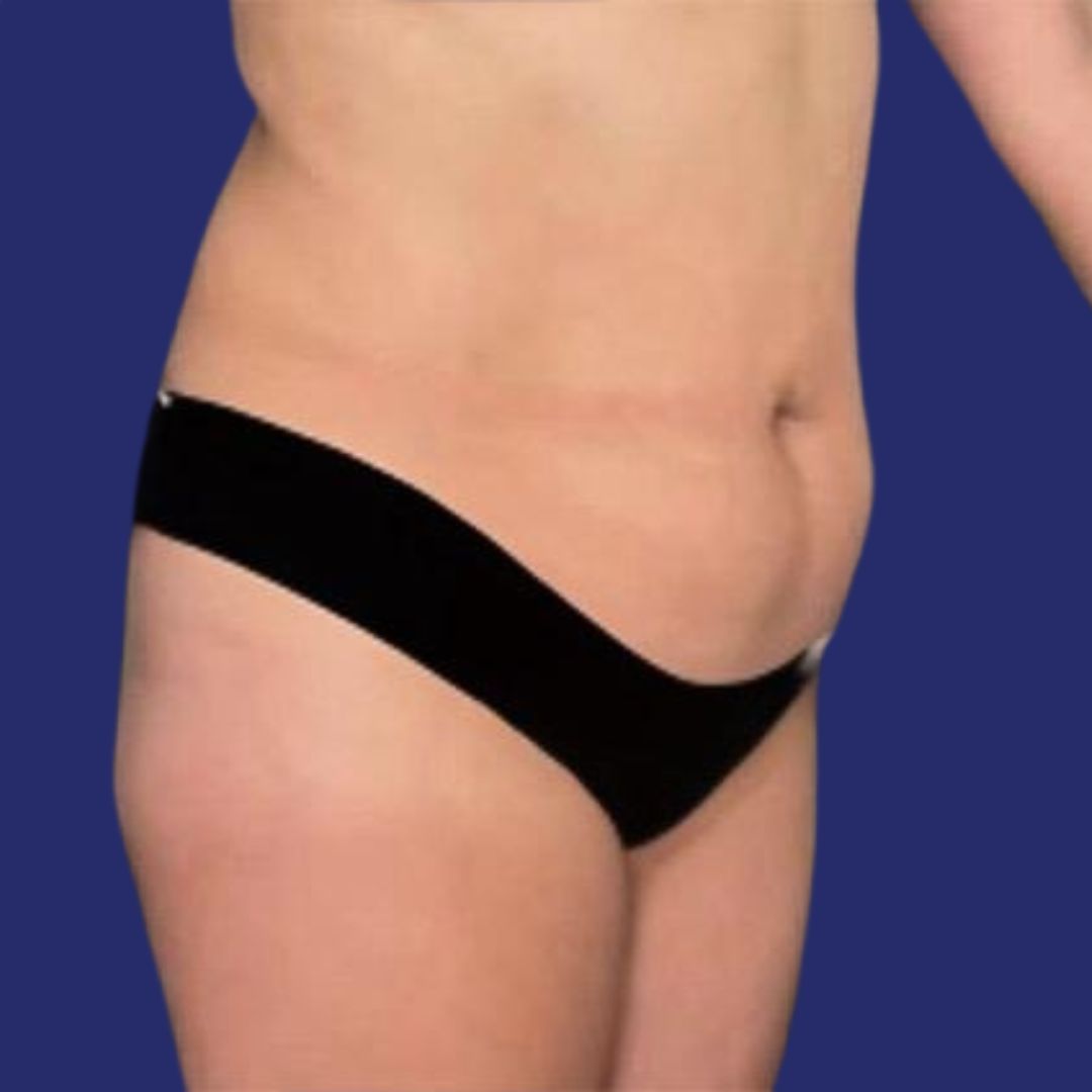 Abdomen antes de abdominoplastia tras pérdida peso piel colgante