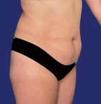 Abdomen before abdominoplasty after weight loss with hanging skin