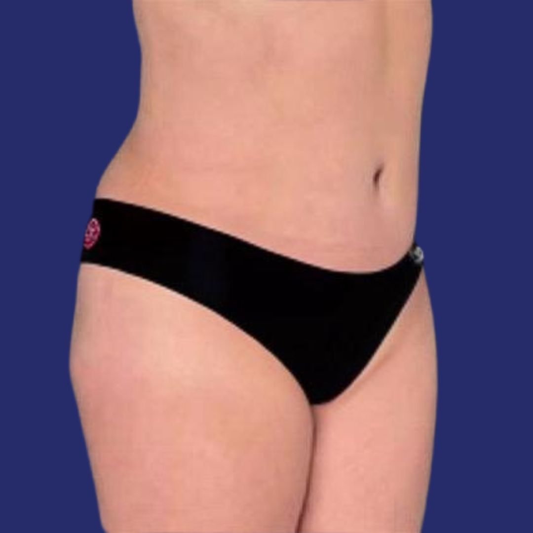 Resultado estético de abdominoplastia mejorar flacidez de la piel