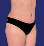 Aesthetic result of abdominoplasty to improve skin laxity