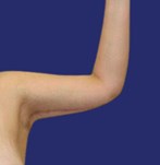 Brazos definidos con mejor contorno tras braquioplastia
