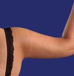 Brazos tonificados y esculpidos después de la braquioplastia.