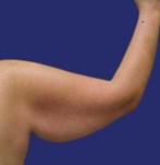 Paciente con flacidez visible en la parte inferior del brazo antes de la cirugía de lifting de brazos.