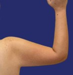 Brazos con piel tensa y tonificada tras la cirugía de braquioplastia.