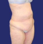 Before thigh lift combined with abdominoplasty: lateral view showing flaccidity in the thigh area and lack of defined body contour.