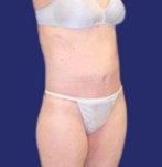 After thigh lift combined with abdominoplasty: lateral view revealing improved firmness and removal of sagging skin in the thigh area.