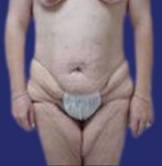 Frontal image before thigh lift and tummy tuck, showing loose skin and lack of firmness in the inner thighs
