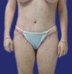 After thigh lift and tummy tuck surgery, frontal image showing the improved appearance of the legs, with firmer and more defined thighs.