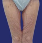 Before thigh lift: appearance of legs with excess skin and flaccidity due to weight loss in the upper thighs.