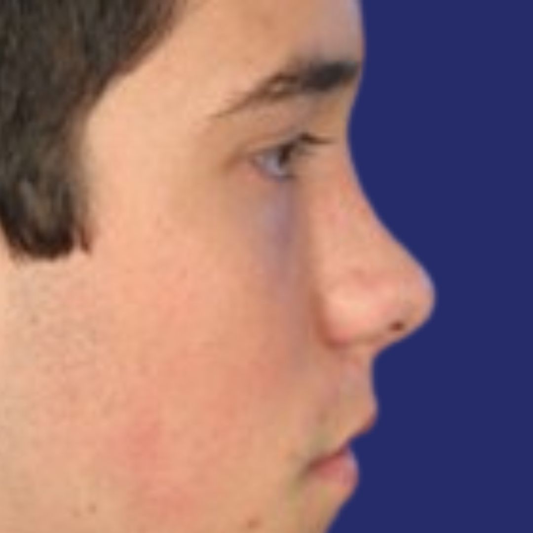 Before rhinoplasty, natural nasal profile without cosmetic correction