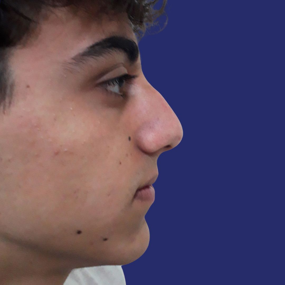 Nose with drooping tip before rhinoplasty procedure
