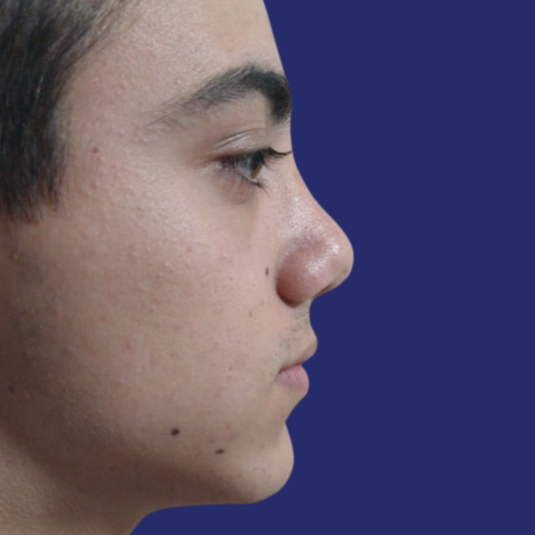  Lifted, harmonious nasal tip after rhinoplasty in Barcelona