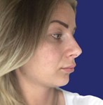 Rostro antes de la cirugía estética de nariz en Barcelona