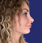 Nariz refinada y resultado natural tras cirugía estética de nariz