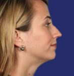 Perfil lateral antes de la rinoplastia, punta gruesa y tabique desviado