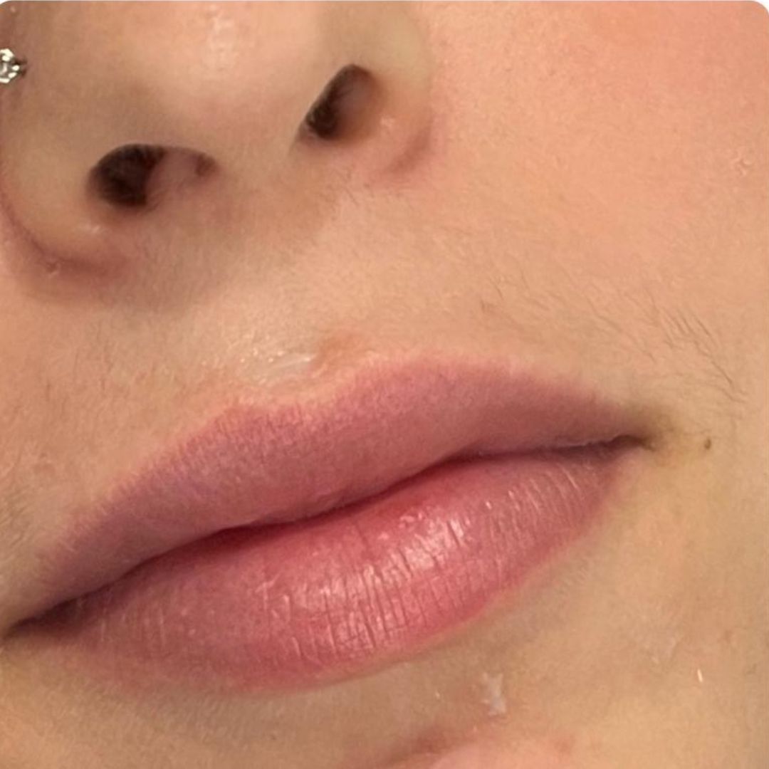 Imagen de los labios antes del tratamiento, con volumen natural.